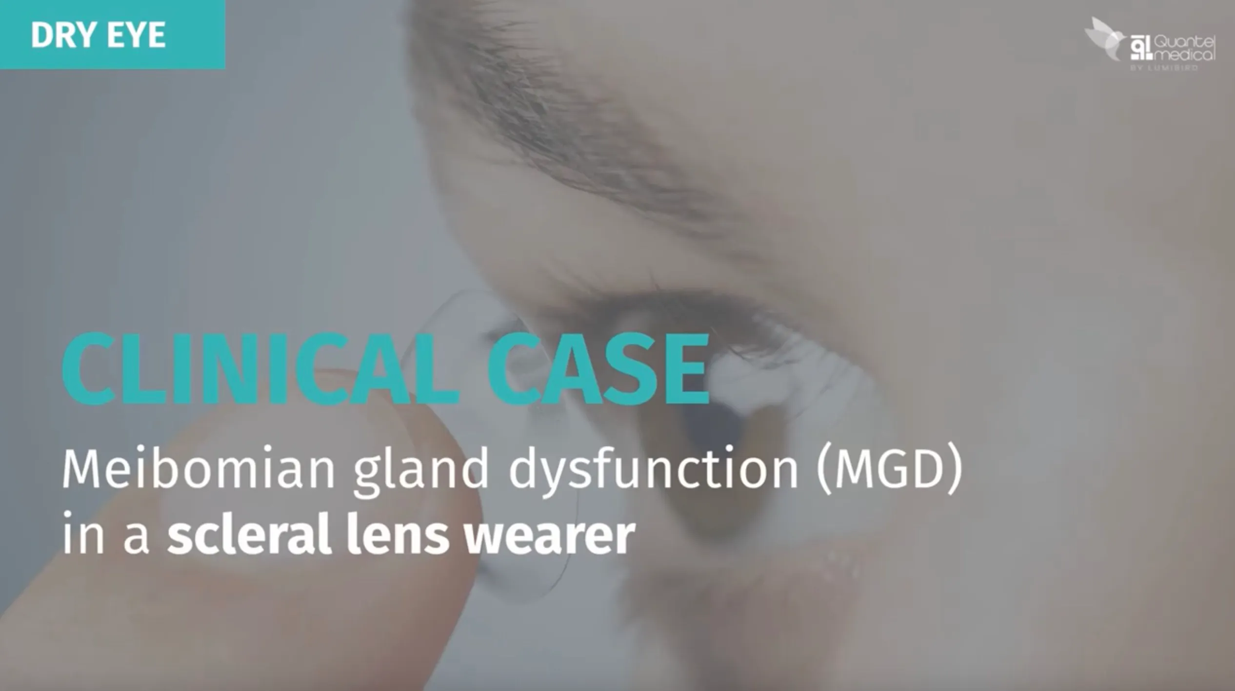 Clinical Case: Meibomian Gland Dysfunction (MGD) in a Scleral Lens ...